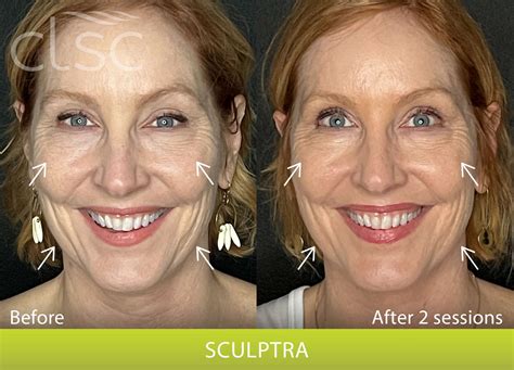 sculptra   columbia laser skin center