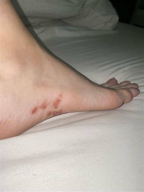 Red rash : r/Dermatology