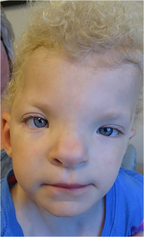 Syndromic Craniofacial Disorders - Facial Plastic Surgery Clinics