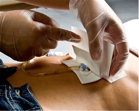 PEG-Anwendungsstudie gestartet - ALS-Ambulanz