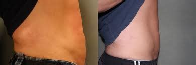 Radio Frequency Body Contouring | NYC Rejuvenation Clinic