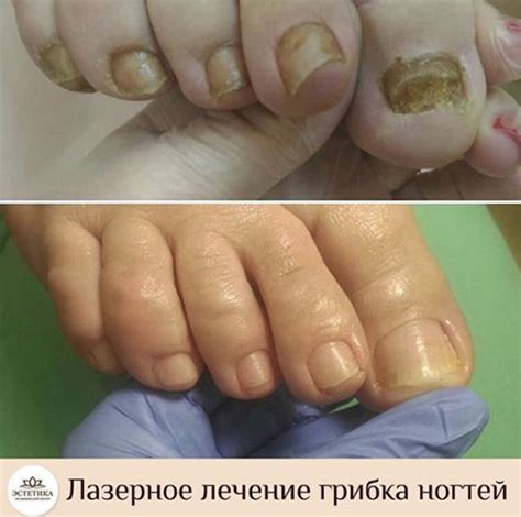 Грибка на ногтях лечение