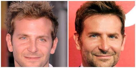 Bradley Cooper Hair Transplant: Did He Have One? | Longevita