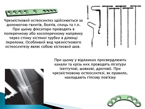 Остеосинтез - презентация онлайн