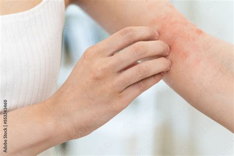 Sensitive skin allergic concept, Woman itching on her arm have a red ...