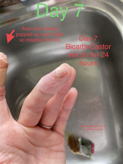 Update on the 10 year Wart. I feel maybe starting to see skin lines! Do