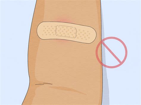 How to Properly Place a TB Skin Test (with Pictures) - wikiHow