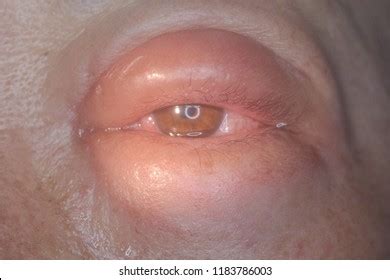 Fungal Eye Infections: Over 439 Royalty-Free Licensable Stock Photos ...