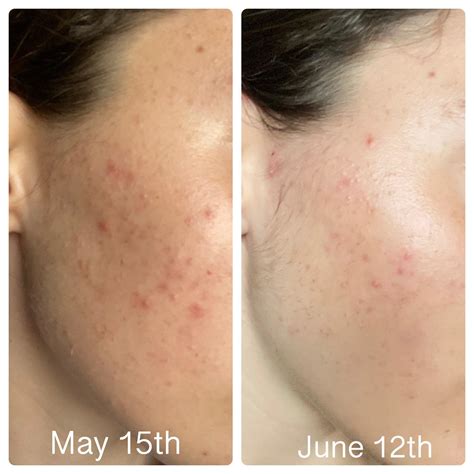 vegan diet + water only washing + salicylic acid pads. What a month can