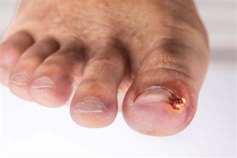 Ingrown Toenail Infection: Symptoms, Treatment, Causes