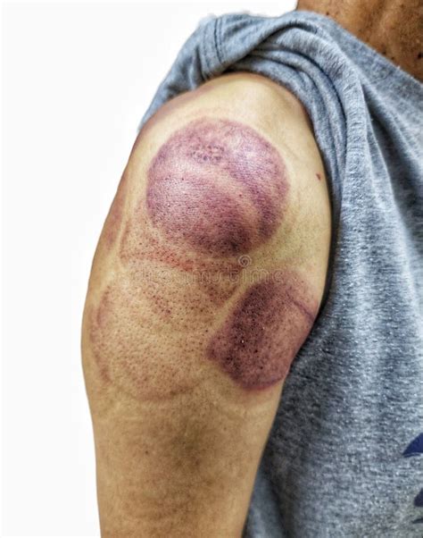 woman  arm  blood marks   chinese cupping therapy
