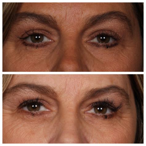 Face - Echelon Surgical Specialists