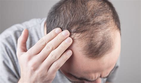 Lexapro Hair Loss: Is It a Thing? - Cosmedica Clinic