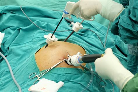 Gall bladder surgery – Laparoscopic cholecystectomy | Affinity Surgery ...