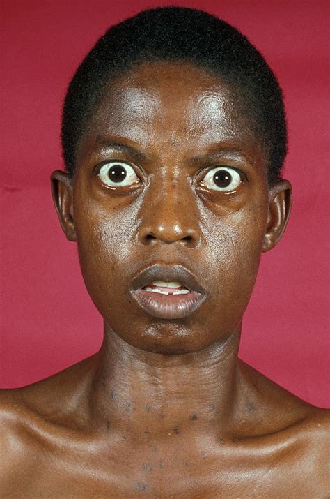 graves disease photograph  dr ma ansaryscience photo library pixels