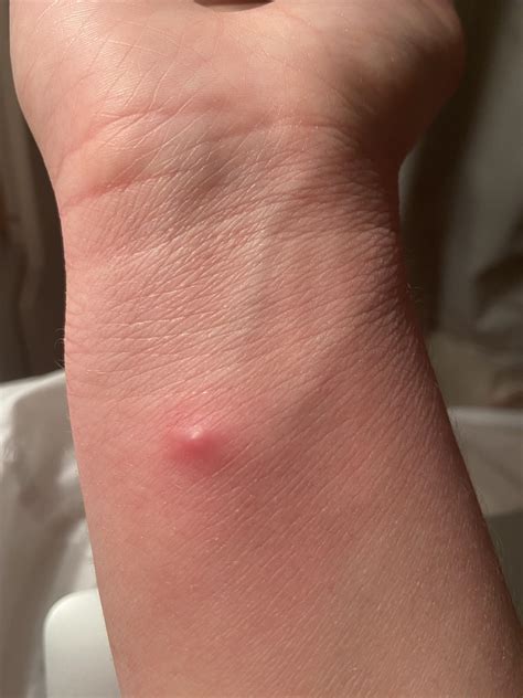 Strange cyst/spot/whitehead? So basically I had a small spot here on my