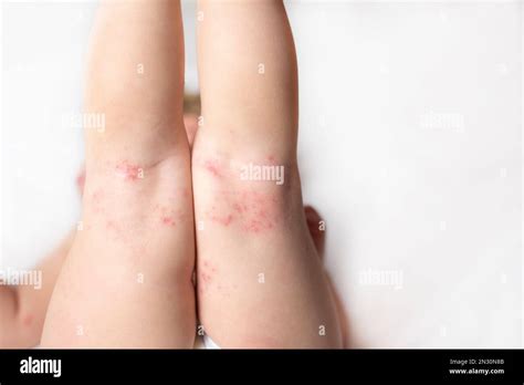 Hand, Foot, and Mouth disease rash on a baby's legs. Coxsackie virus ...