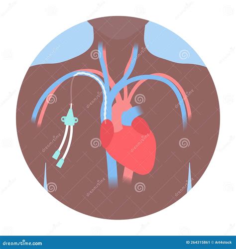 tunneled central  venous catheter medical diagram cartoon vector
