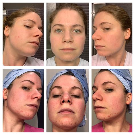 Forum Candid: The Unexpected Side Effects (You Need To Know!) Image 15