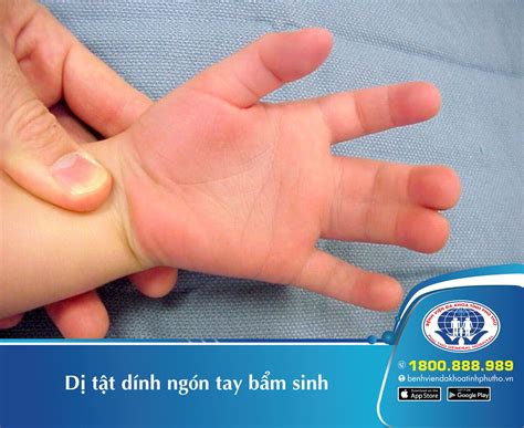 Dị tật dính ngón tay bẩm sinh – 5 điều cần biết