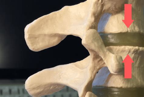 disc space narrowing archives spinal backrack