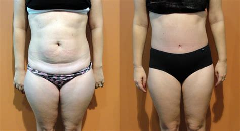 Como Fica A Barriga Depois Da Abdominoplastia - Abdominoplastia - fotos preço antes e depois
