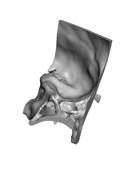 left temporal surgistud