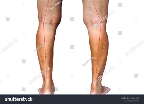 how to become bow legged