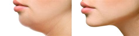 How to remove under-chin fat?