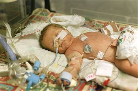 Premature birth | Definition, Causes, & Health Effects | Britannica