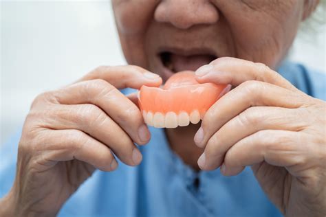 Upper Partial Dentures | Stomadent Dental Lab