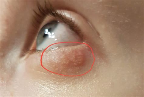 Ausschlag Unterm Auge: Ursachen, Symptome & Behandlung | Hebamme FZ