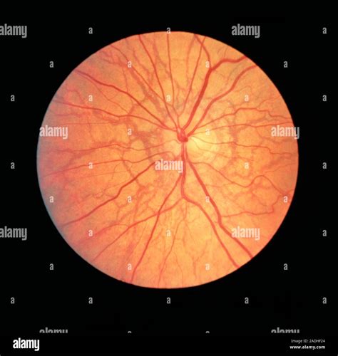 angioid streaks pseudoxanthoma ophthalmoscope view   retina