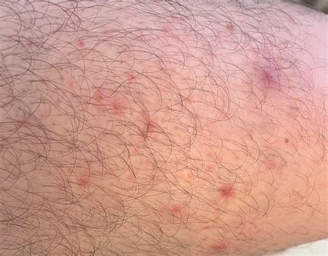Help identify rash : r/DermatologyQuestions