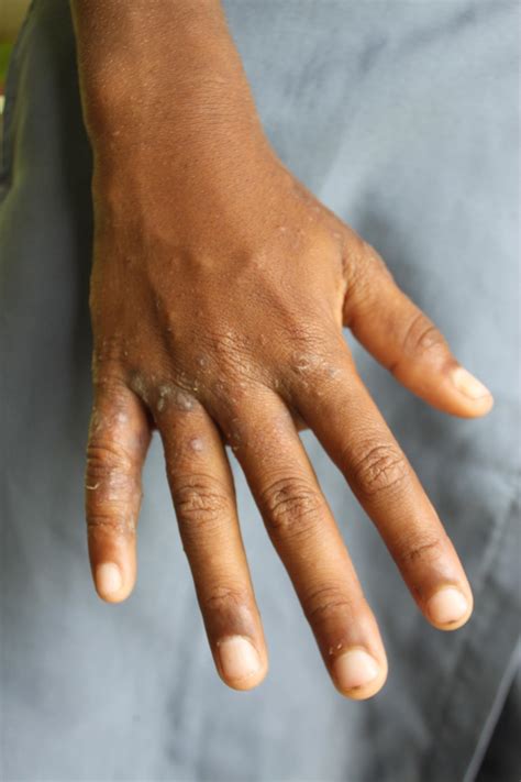 Scabies On Hands