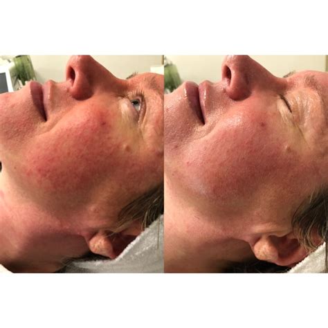 Skin Transformation Programs - Shabana Bashir The Skin Consultant