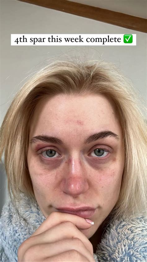 Elle Brooke left black and blue as she shares results of brutal