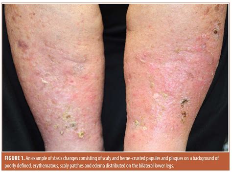 Stasis Dermatitis: Pathophysiology, Current Treatment Paradigms, and ...