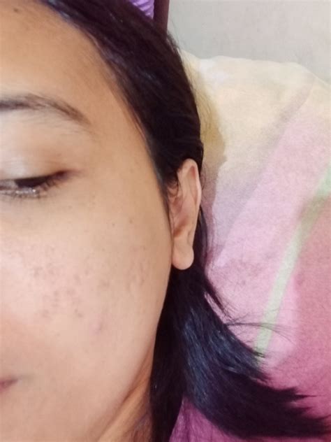 kulit berjerawat hellosehat