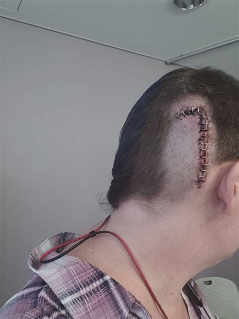 VP shunt surgery : r/iih