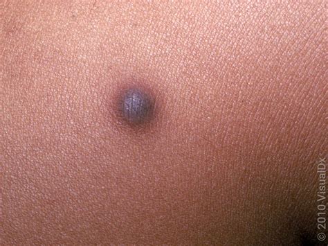 O Que É Dermatofibroma