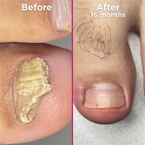 Nail Discoloration – Footlogix®