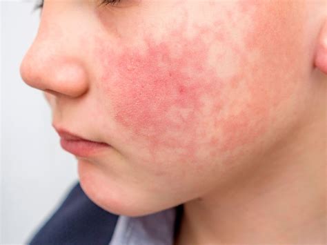 Common childhood skin rashes with pictures: what rash is this? - Which?