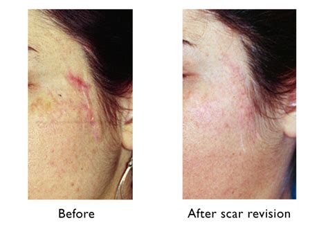 scars unc center  facial aesthetics