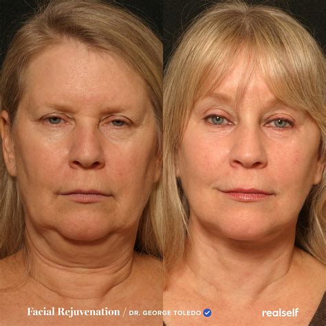 treatments  jowls  botox  jowls  face lift cost