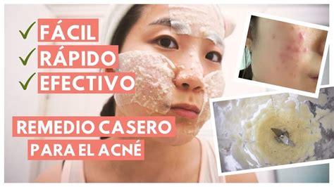 Adiós al acné facial: remedios caseros rápidos y efectivos