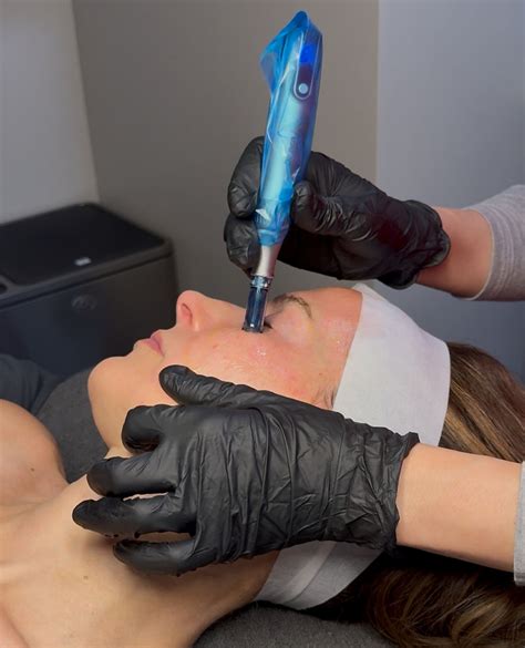 discover microneedling benefits  radiant skin  natural lash skin bar