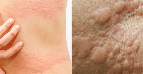 Coceira No Corpo Com Bolinhas Vermelhas O Que Pode Ser