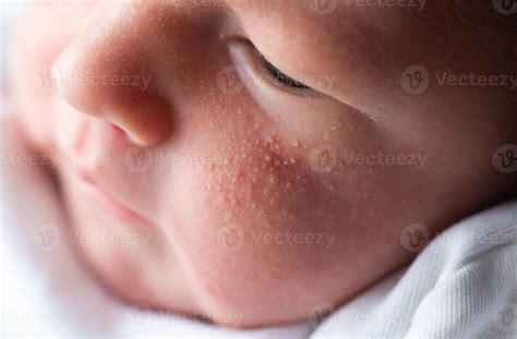 how to get rid of newborn pimples 8