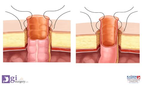 stoma techniques  constructionpdf